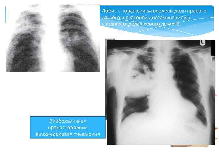 Лобит с поражением верхней доли правого легкого и очаговой диссеминацией в средних отделах левого