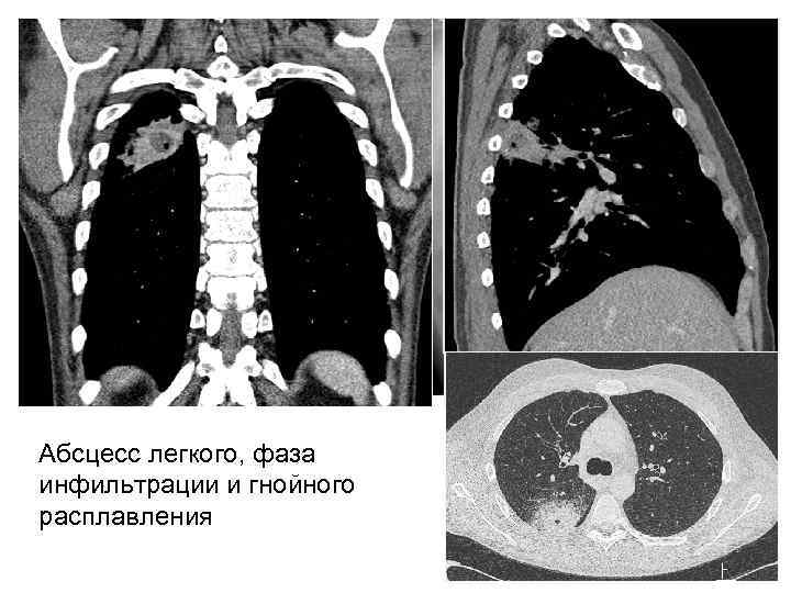 Абсцесс легкого, фаза инфильтрации и гнойного расплавления 