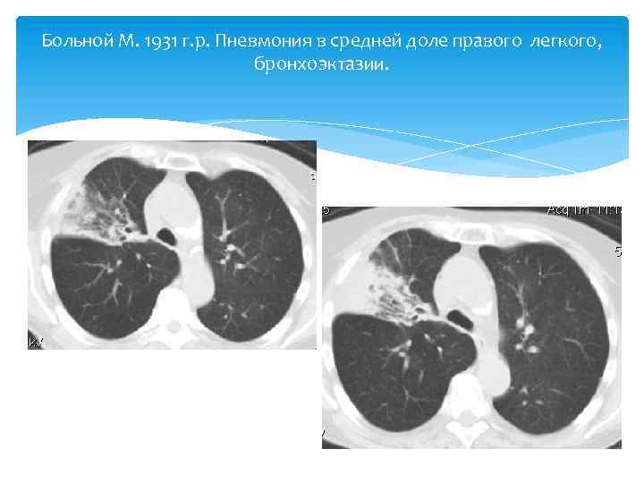 Больной М. 1931 г. р. Пневмония в средней доле правого легкого, бронхоэктазии. 