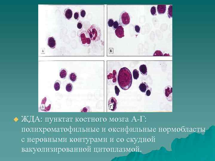 u ЖДА: пунктат костного мозга А-Г: полихроматофильные и оксифильные нормобласты с неровными контурами и