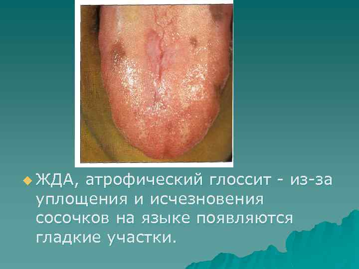 u ЖДА, атрофический глоссит - из-за уплощения и исчезновения сосочков на языке появляются гладкие