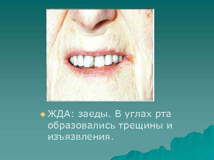 u ЖДА: заеды. В углах рта образовались трещины и изъязвления. 