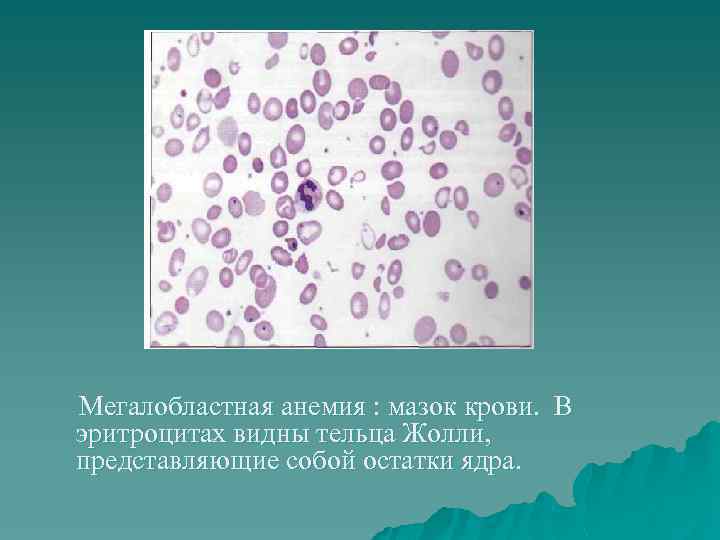  Мегалобластная анемия : мазок крови. В эритроцитах видны тельца Жолли, представляющие собой остатки