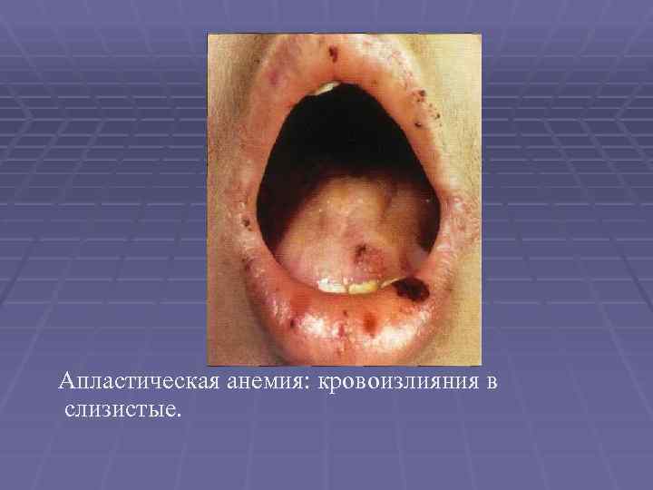 Апластическая анемия: кровоизлияния в слизистые. 