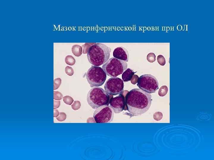Мазок периферической крови при ОЛ 