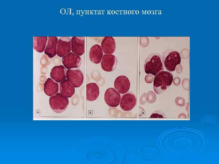 ОЛ, пунктат костного мозга 