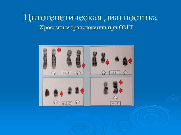 Цитогенетическая диагностика Хросомные транслокации при ОМЛ 