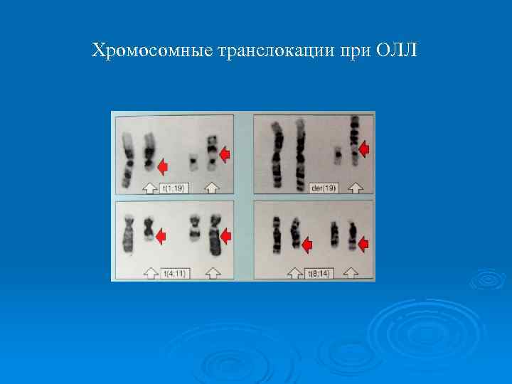 Хромосомные транслокации при ОЛЛ 