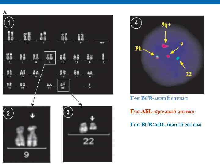 Ген BCR-синий сигнал Ген ABL-красный сигнал Ген BCR/ABL-белый сигнал 