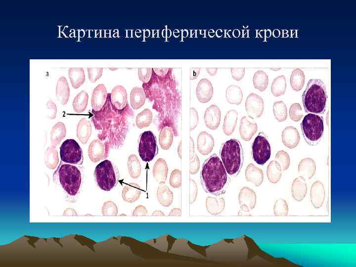 Картина периферической крови 