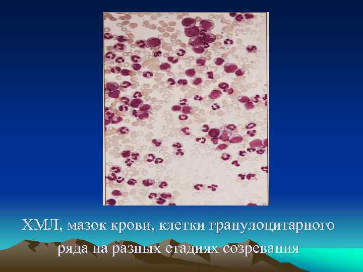 ХМЛ, мазок крови, клетки гранулоцитарного ряда на разных стадиях созревания 