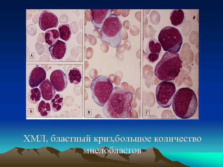 ХМЛ, бластный криз, большое количество миелобластов 