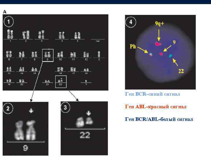 Ген BCR-синий сигнал Ген ABL-красный сигнал Ген BCR/ABL-белый сигнал 