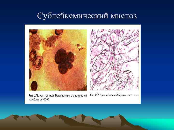 Сублейкемический миелоз 