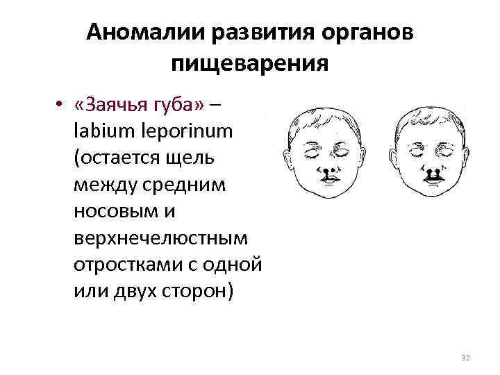 Аномалии развития органов пищеварения • «Заячья губа» – labium leporinum (остается щель между средним