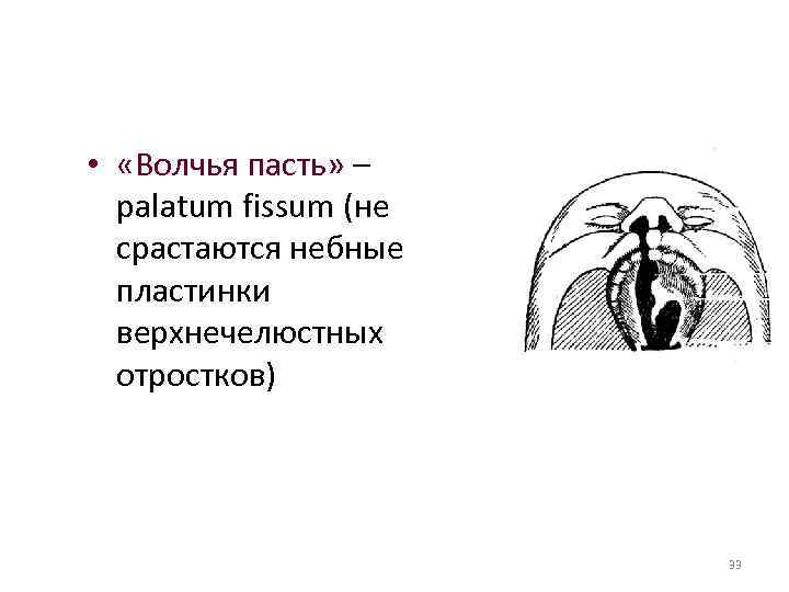  • «Волчья пасть» – palatum fissum (не срастаются небные пластинки верхнечелюстных отростков) 33