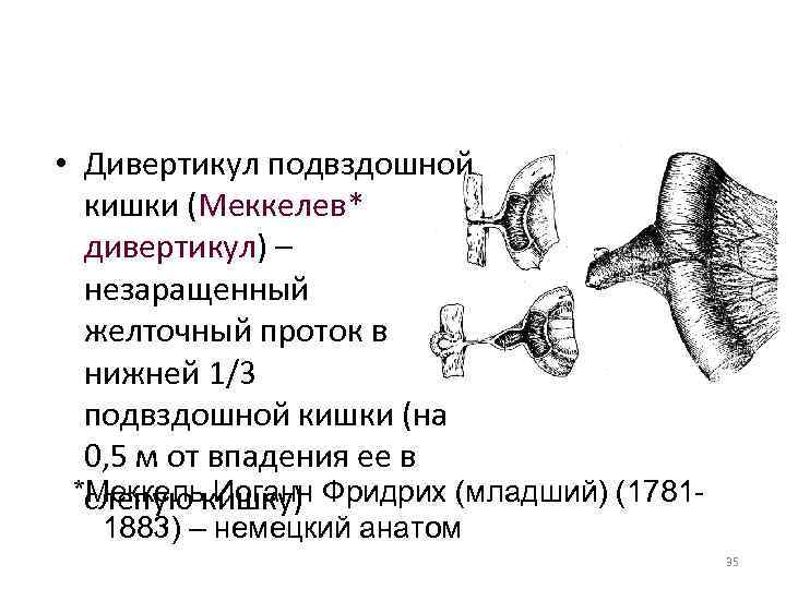  • Дивертикул подвздошной кишки (Меккелев* дивертикул) – незаращенный желточный проток в нижней 1/3