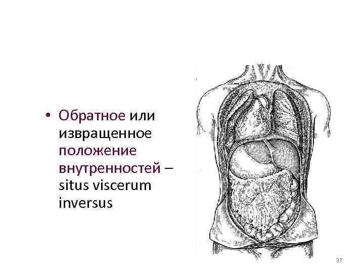  • Обратное или извращенное положение внутренностей – situs viscerum inversus 37 