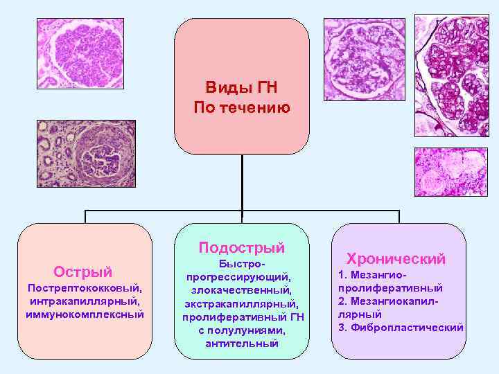 Виды ГН По течению Подострый Острый Пострептококковый, интракапиллярный, иммунокомплексный Быстропрогрессирующий, злокачественный, экстракапиллярный, пролиферативный ГН