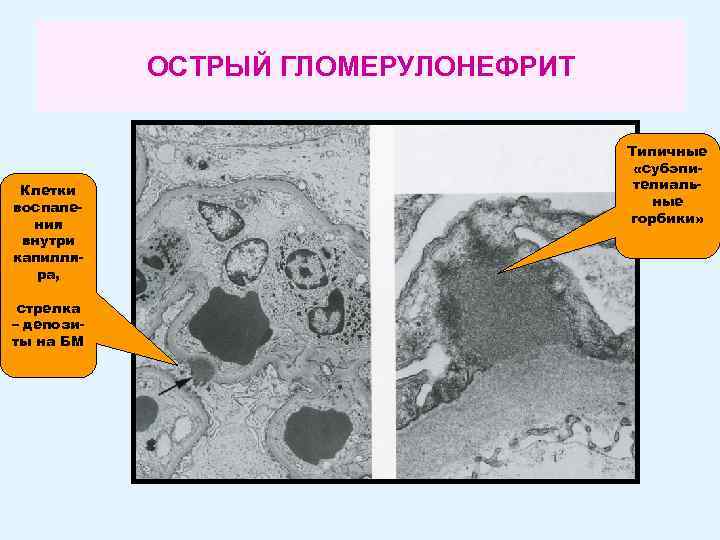 ОСТРЫЙ ГЛОМЕРУЛОНЕФРИТ Клетки воспаления внутри капилляра, стрелка – депозиты на БМ Типичные «субэпителиальные горбики»