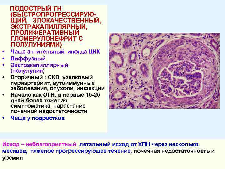 ПОДОСТРЫЙ ГН (БЫСТРОПРОГРЕССИРУЮЩИЙ, ЗЛОКАЧЕСТВЕННЫЙ, ЭКСТРАКАПИЛЛЯРНЫЙ, ПРОЛИФЕРАТИВНЫЙ ГЛОМЕРУЛОНЕФРИТ С ПОЛУЛУНИЯМИ) • • • Чаще антительный,
