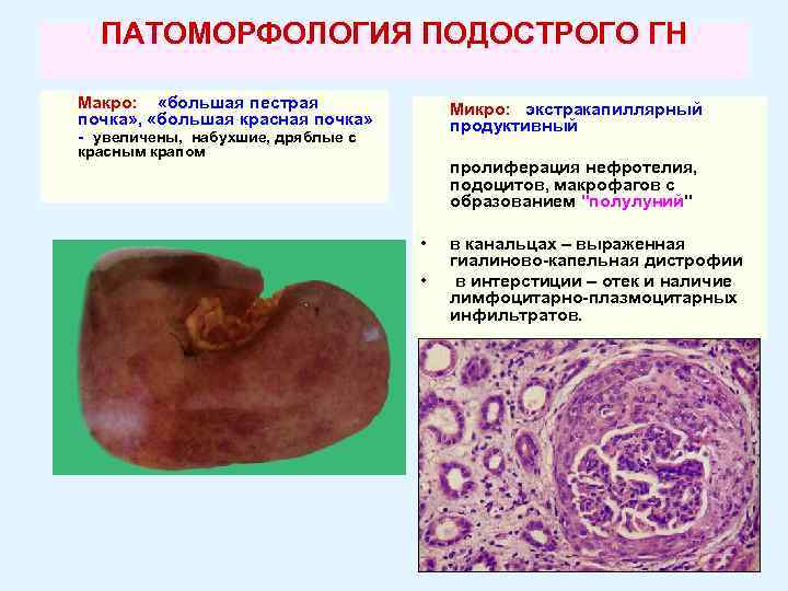 ПАТОМОРФОЛОГИЯ ПОДОСТРОГО ГН Макро: «большая пестрая почка» , «большая красная почка» - увеличены, набухшие,