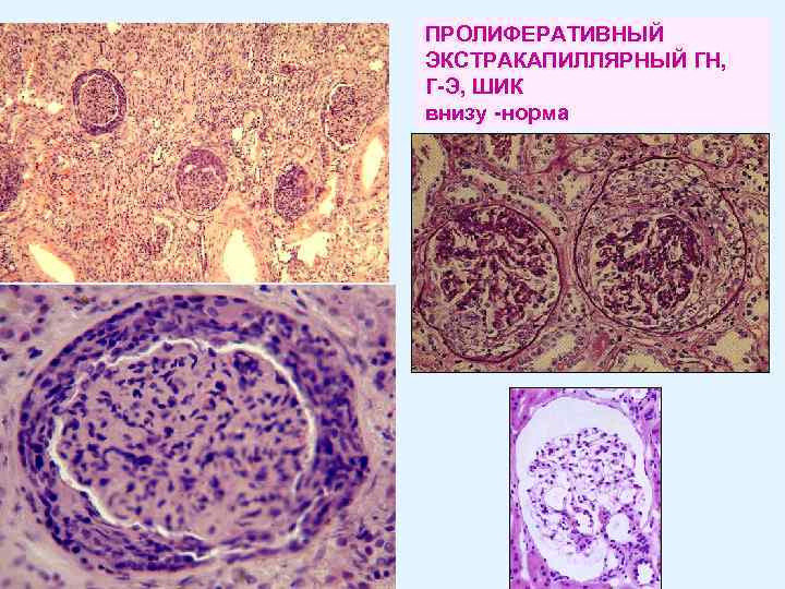 ПРОЛИФЕРАТИВНЫЙ ЭКСТРАКАПИЛЛЯРНЫЙ ГН, Г-Э, ШИК внизу -норма 
