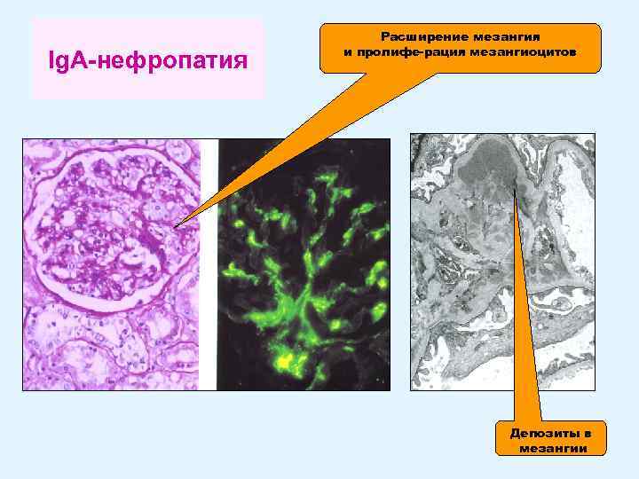 Ig. A-нефропатия Расширение мезангия и пролифе-рация мезангиоцитов Депозиты в мезангии 