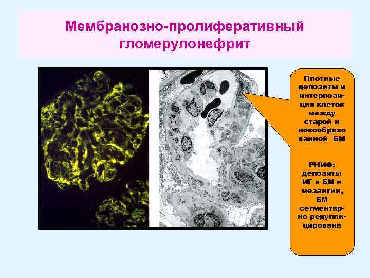 Мембранозно-пролиферативный гломерулонефрит Плотные депозиты и интерпозиция клеток между старой и новообразо ванной БМ РНИФ: