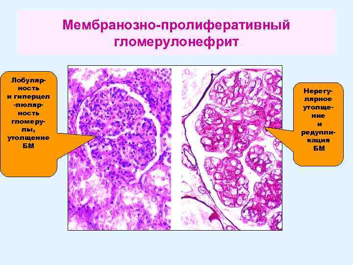 Мембранозно-пролиферативный гломерулонефрит Лобулярность и гиперцел -люлярность гломерулы, утолщение БМ Нерегулярное утолщение и редупликация БМ