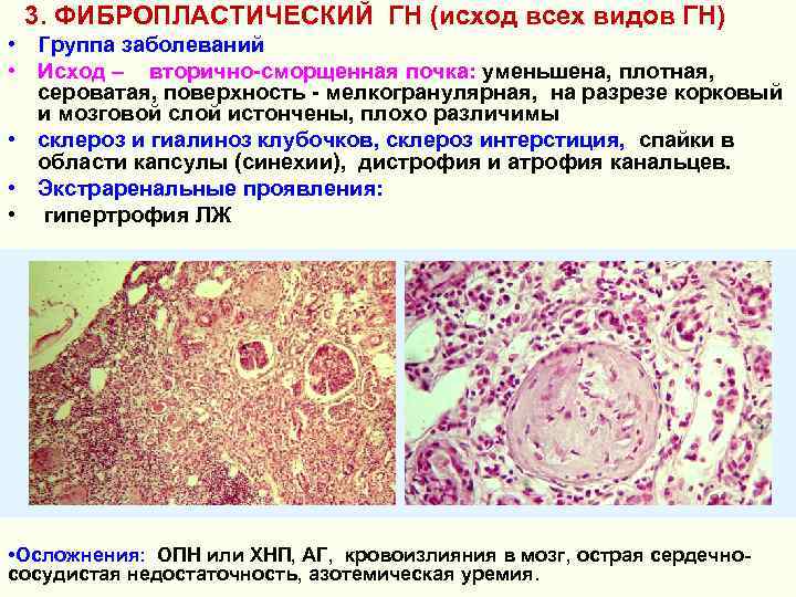 3. ФИБРОПЛАСТИЧЕСКИЙ ГН (исход всех видов ГН) • Группа заболеваний • Исход – вторично-сморщенная
