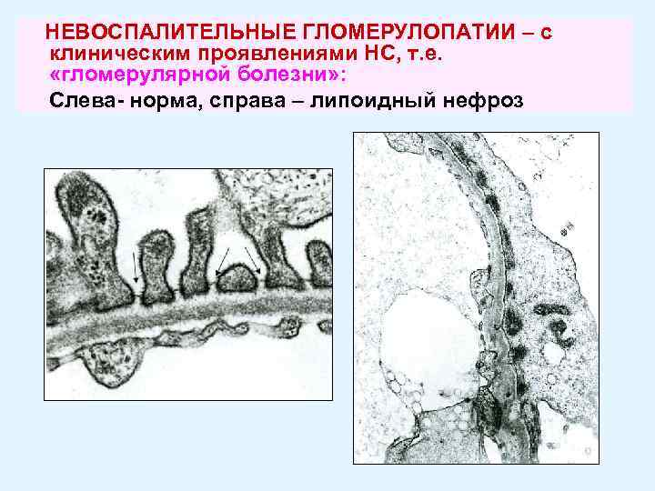 НЕВОСПАЛИТЕЛЬНЫЕ ГЛОМЕРУЛОПАТИИ – с клиническим проявлениями НС, т. е. «гломерулярной болезни» : Слева- норма,