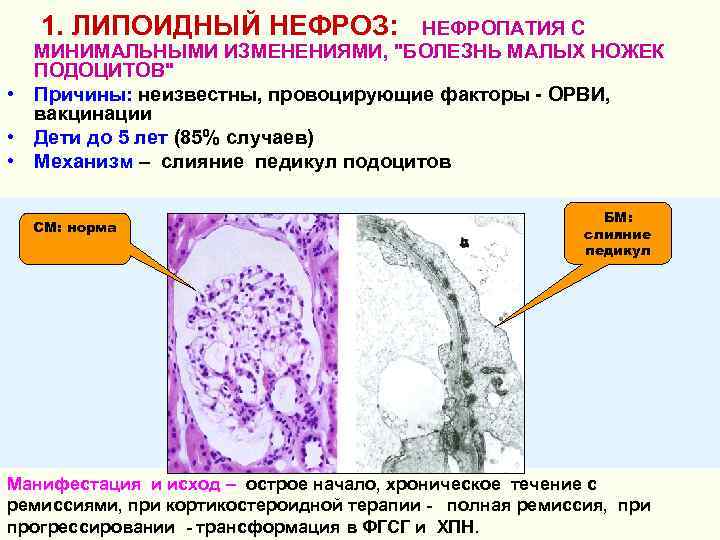 1. ЛИПОИДНЫЙ НЕФРОЗ: НЕФРОПАТИЯ С МИНИМАЛЬНЫМИ ИЗМЕНЕНИЯМИ, "БОЛЕЗНЬ МАЛЫХ НОЖЕК ПОДОЦИТОВ" • Причины: неизвестны,