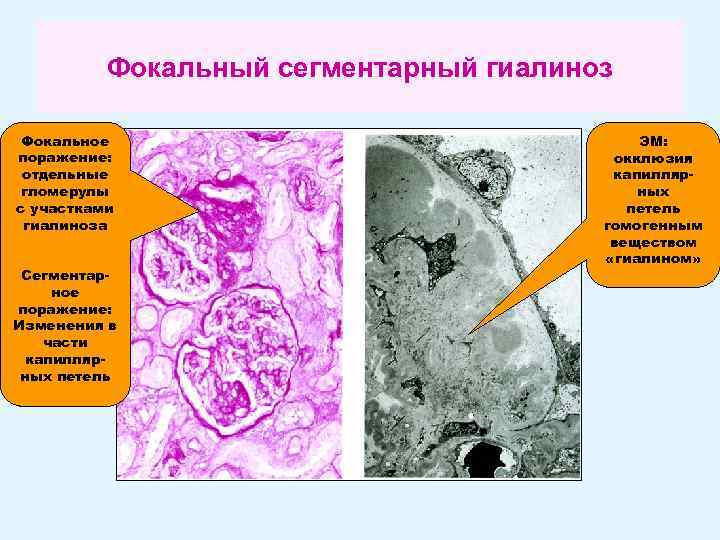 Фокальный сегментарный гиалиноз Фокальное поражение: отдельные гломерулы с участками гиалиноза Сегментарное поражение: Изменения в