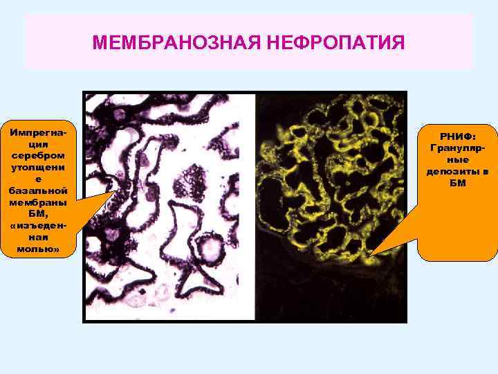 МЕМБРАНОЗНАЯ НЕФРОПАТИЯ Импрегнация серебром утолщени е базальной мембраны БМ, «изъеденная молью» РНИФ: Гранулярные депозиты