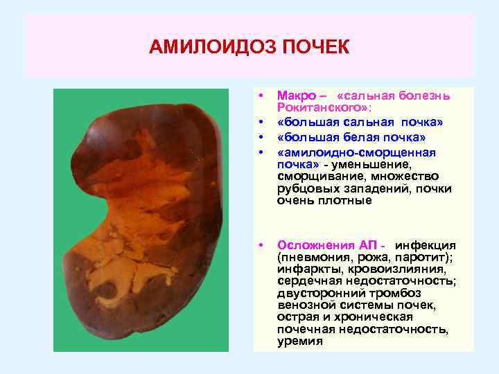АМИЛОИДОЗ ПОЧЕК • • • Макро – «сальная болезнь Рокитанского» : «большая сальная почка»
