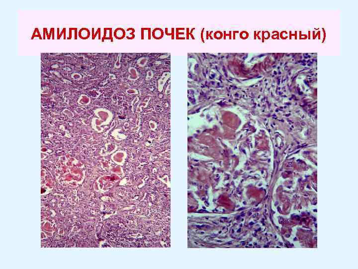 АМИЛОИДОЗ ПОЧЕК (конго красный) 