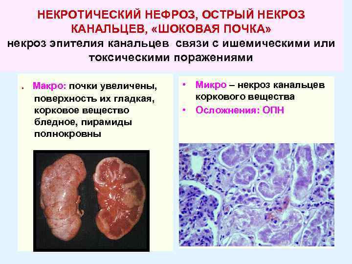 НЕКРОТИЧЕСКИЙ НЕФРОЗ, ОСТРЫЙ НЕКРОЗ КАНАЛЬЦЕВ, «ШОКОВАЯ ПОЧКА» некроз эпителия канальцев связи с ишемическими или