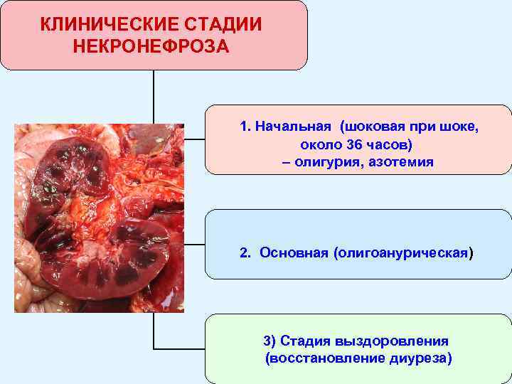 КЛИНИЧЕСКИЕ СТАДИИ НЕКРОНЕФРОЗА 1. Начальная (шоковая при шоке, около 36 часов) – олигурия, азотемия