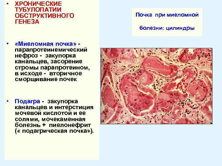  • ХРОНИЧЕСКИЕ ТУБУЛОПАТИИ ОБСТРУКТИВНОГО ГЕНЕЗА • «Миеломная почка» парапротеинемический нефроз - закупорка канальцев,