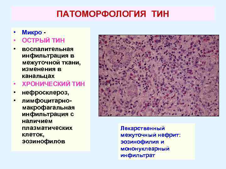 Микро изменение. Воспалительный инфильтрат гистология. Лейкемическая инфильтрация дермы. Мононуклеарнои воспалительная инфильтрация. Инфильтрат полиморфноклеточный микропрепарат.