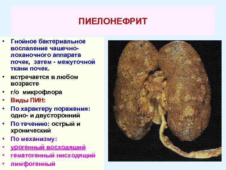 ПИЕЛОНЕФРИТ • Гнойное бактериальное воспаление чашечнолоханочного аппарата почек, затем - межуточной ткани почек. •