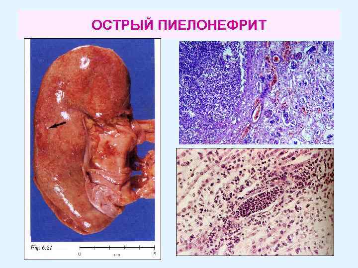 ОСТРЫЙ ПИЕЛОНЕФРИТ 