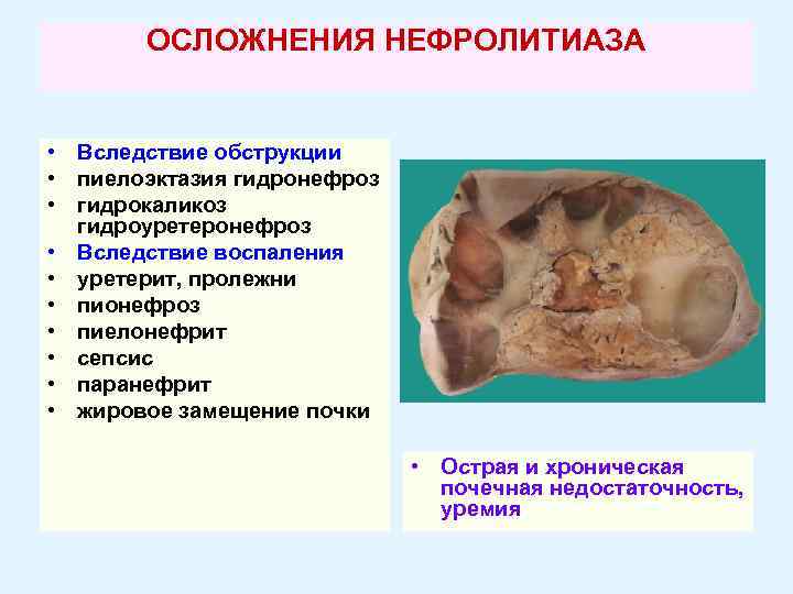 ОСЛОЖНЕНИЯ НЕФРОЛИТИАЗА • Вследствие обструкции • пиелоэктазия гидронефроз • гидрокаликоз гидроуретеронефроз • Вследствие воспаления