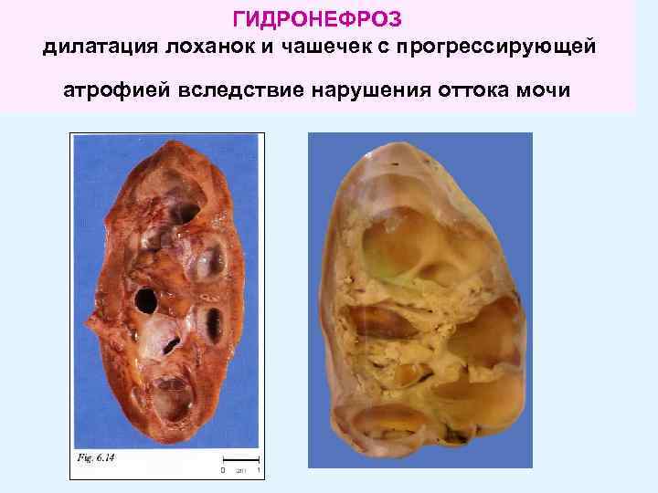 ГИДРОНЕФРОЗ дилатация лоханок и чашечек с прогрессирующей атрофией вследствие нарушения оттока мочи 
