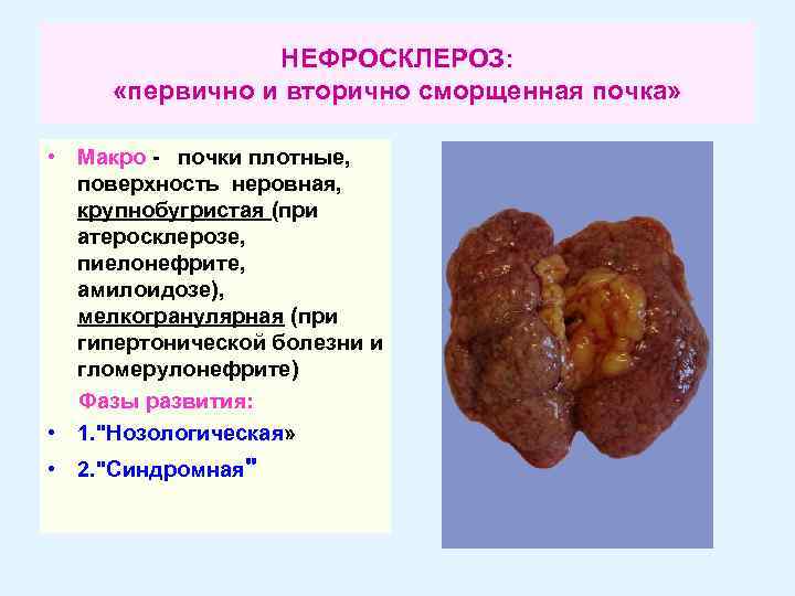 НЕФРОСКЛЕРОЗ: «первично и вторично сморщенная почка» • Макро - почки плотные, поверхность неровная, крупнобугристая