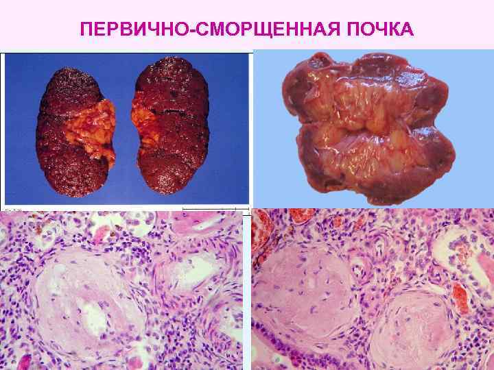 ПЕРВИЧНО-СМОРЩЕННАЯ ПОЧКА 
