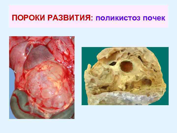 ПОРОКИ РАЗВИТИЯ: поликистоз почек 