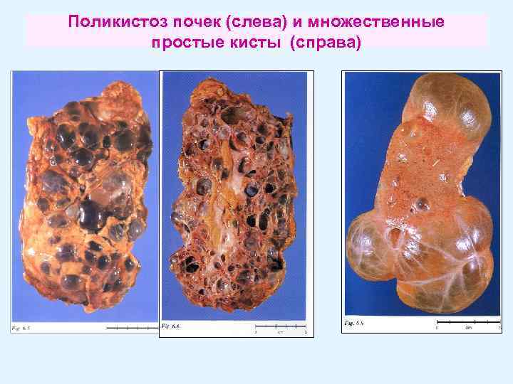 Поликистоз почек (слева) и множественные простые кисты (справа) 