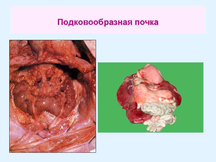 Подковообразная почка 